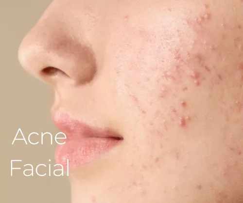 Acne Facial